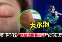 丁当在家煮饭出意外!左眼遭烫伤眼睛睁不开!